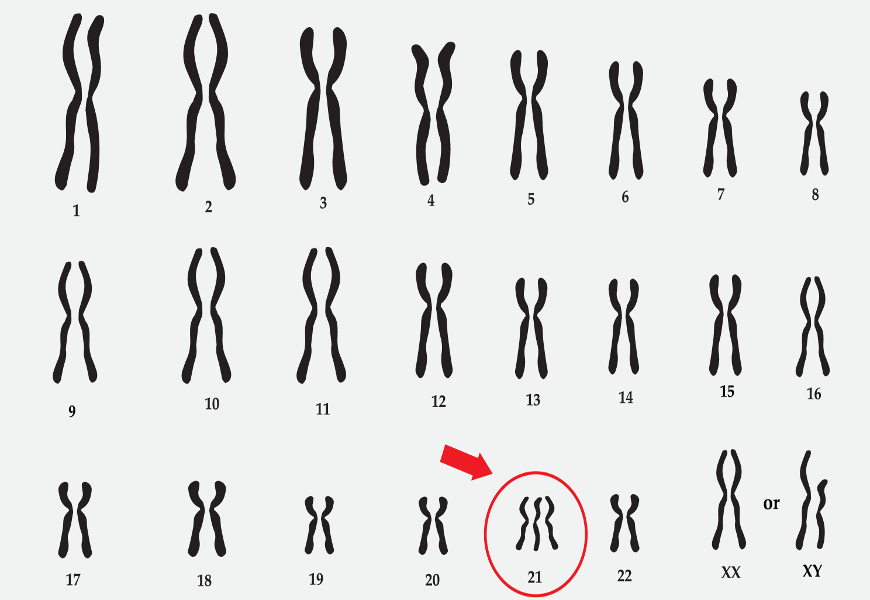 1-trissomia-cromossomica.jpg